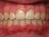 deep overbite after