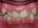 deep overbite before