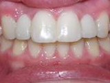 missing lateral incisors after