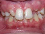 missing lateral incisors before